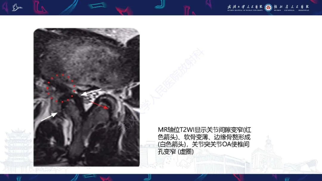 影像PPT - 【PPT】椎旁小关节病变影像诊断-11