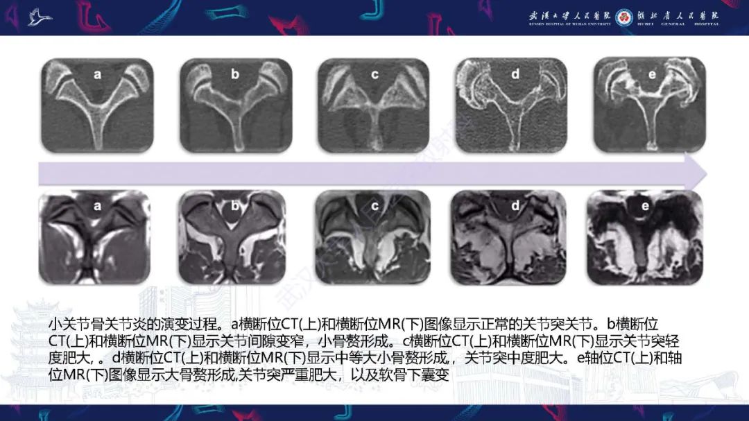影像PPT - 【PPT】椎旁小关节病变影像诊断-10