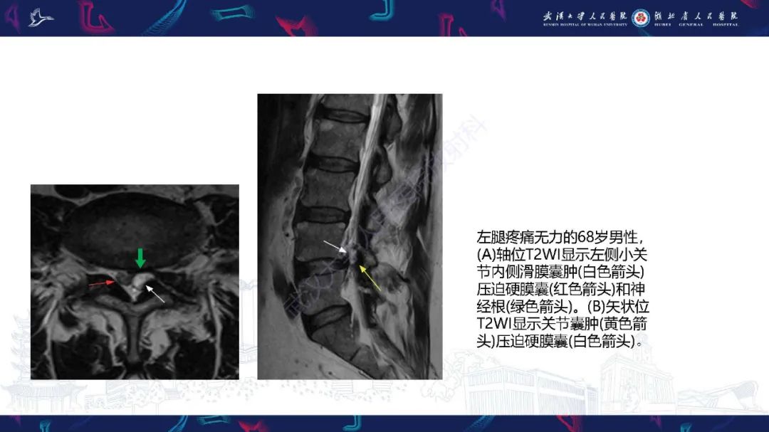 影像PPT - 【PPT】椎旁小关节病变影像诊断-13