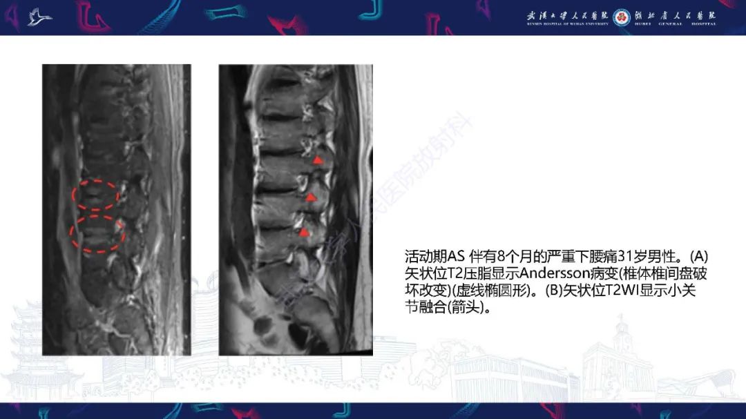 影像PPT - 【PPT】椎旁小关节病变影像诊断-16