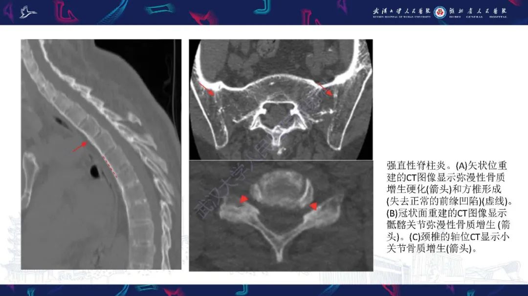 影像PPT - 【PPT】椎旁小关节病变影像诊断-15