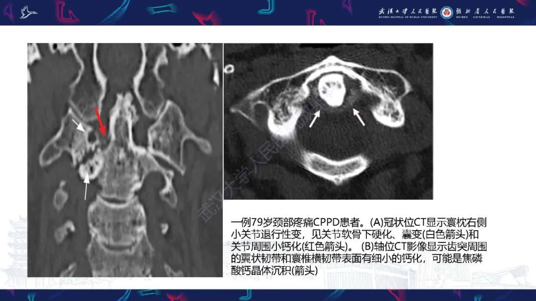 影像PPT - 【PPT】椎旁小关节病变影像诊断-21