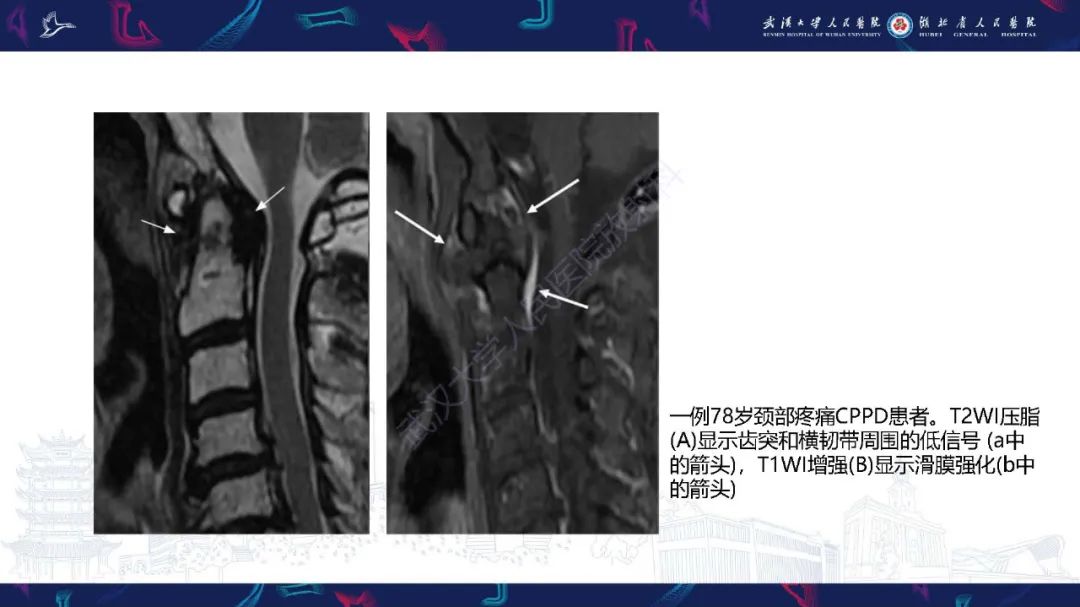 影像PPT - 【PPT】椎旁小关节病变影像诊断-22