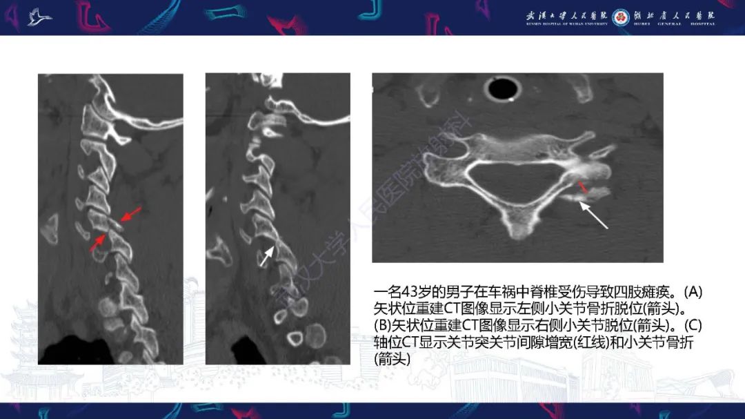影像PPT - 【PPT】椎旁小关节病变影像诊断-25