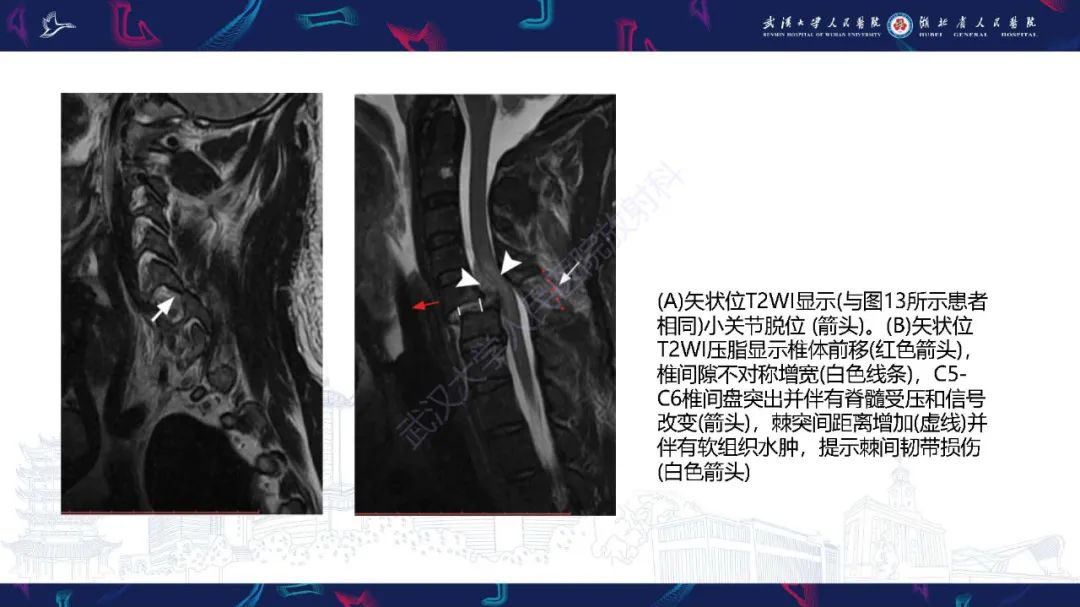 影像PPT - 【PPT】椎旁小关节病变影像诊断-26