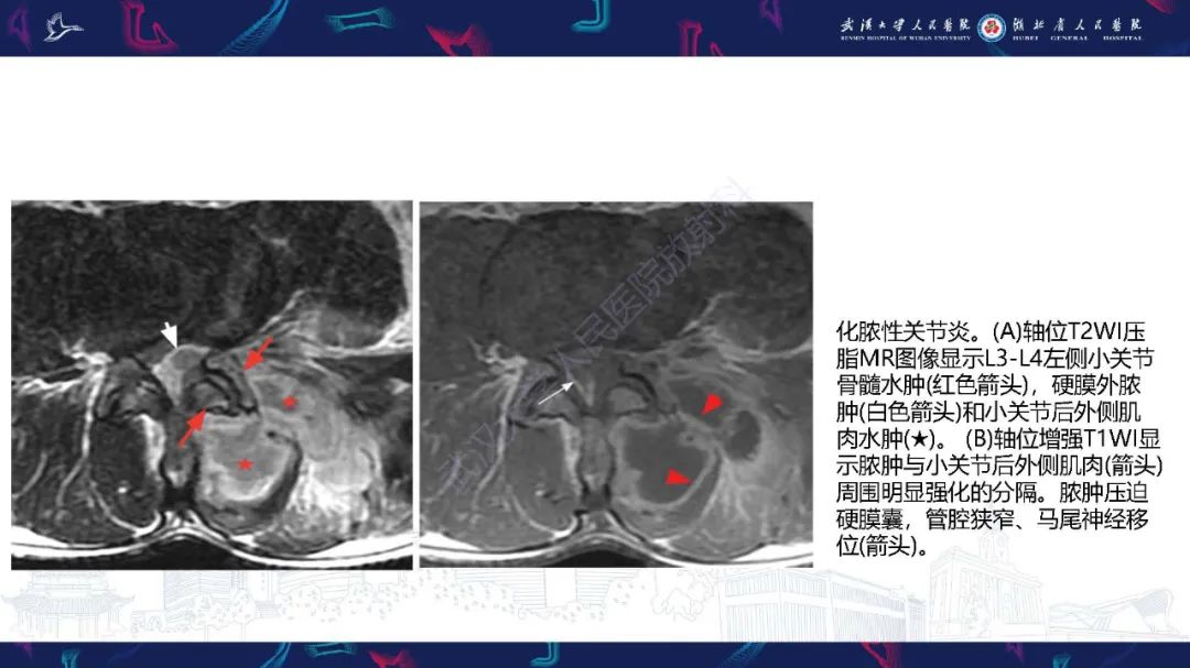 影像PPT - 【PPT】椎旁小关节病变影像诊断-29