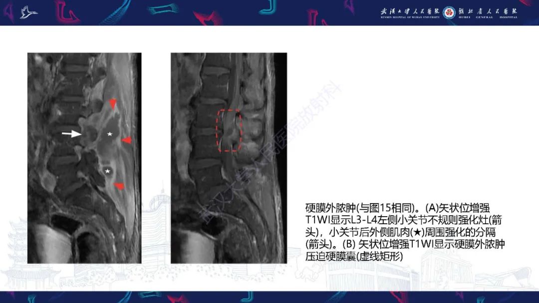 影像PPT - 【PPT】椎旁小关节病变影像诊断-30