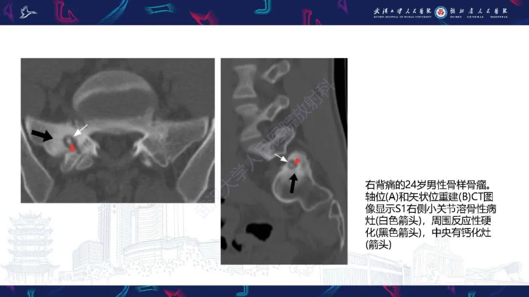 影像PPT - 【PPT】椎旁小关节病变影像诊断-33