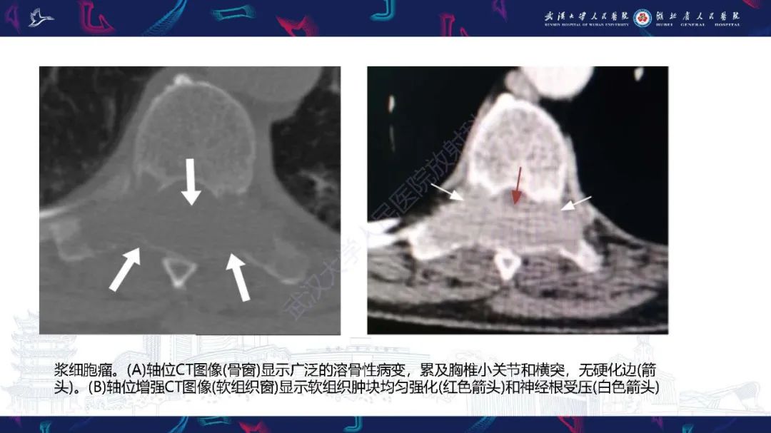 影像PPT - 【PPT】椎旁小关节病变影像诊断-37