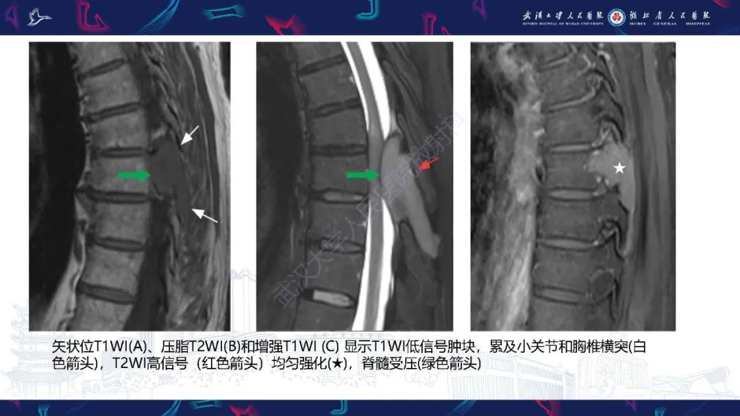 影像PPT - 【PPT】椎旁小关节病变影像诊断-38
