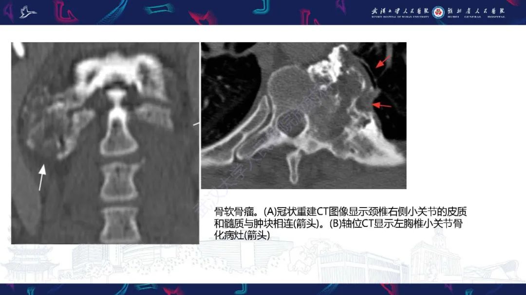影像PPT - 【PPT】椎旁小关节病变影像诊断-44