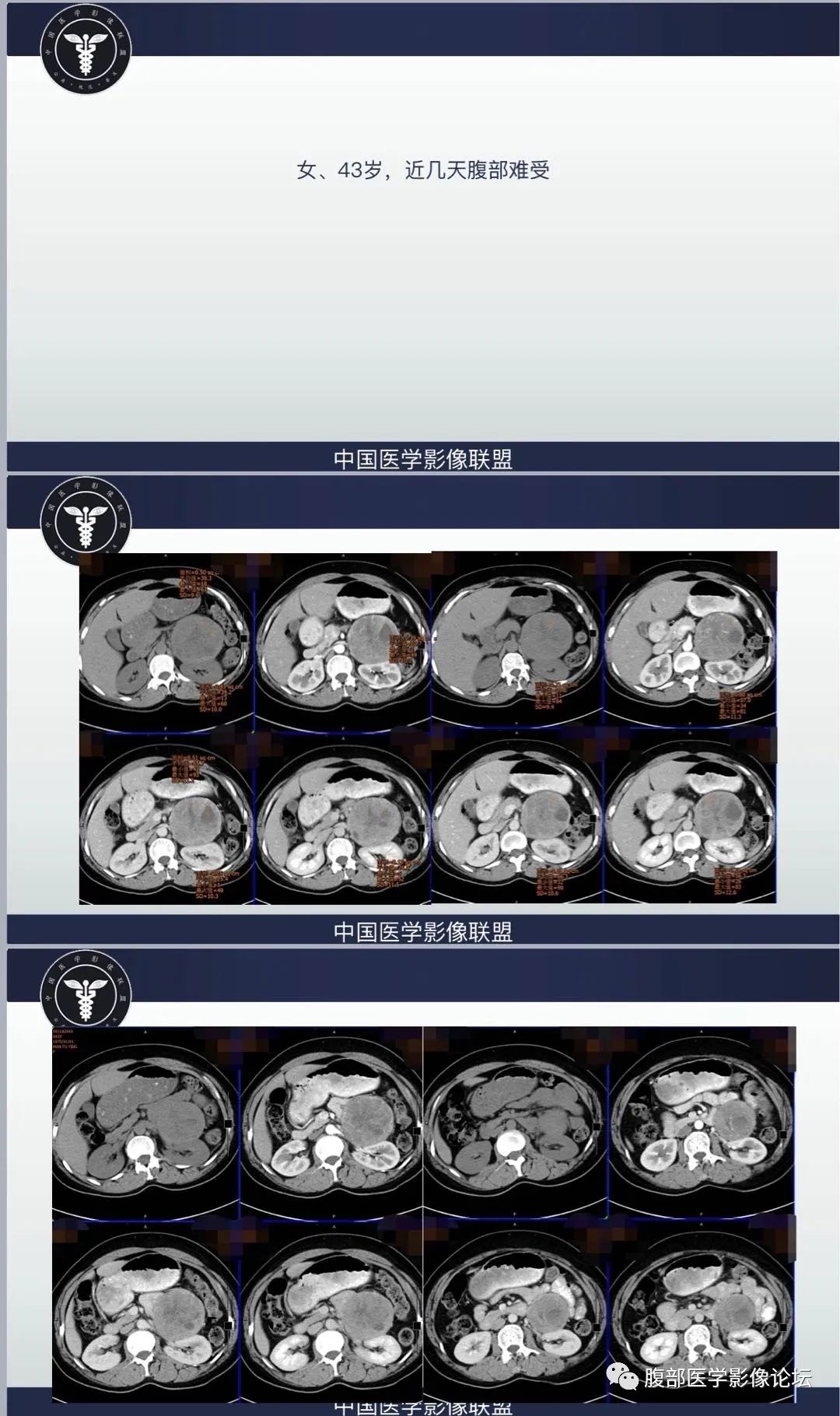 影像PPT - 【病例】腹膜后异位嗜铬细胞瘤1例CT影像-2 影像PPT - 【病例】腹膜后异位嗜铬细胞瘤1例CT影像-2