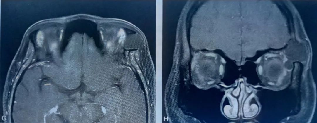 影像PPT - 眼眶皮样囊肿与表皮样囊肿影像诊断-4 影像PPT - 眼眶皮样囊肿与表皮样囊肿影像诊断-4