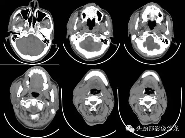 影像PPT - 【病例】颈部淋巴结结核1例CT影像-1 影像PPT - 【病例】颈部淋巴结结核1例CT影像-1