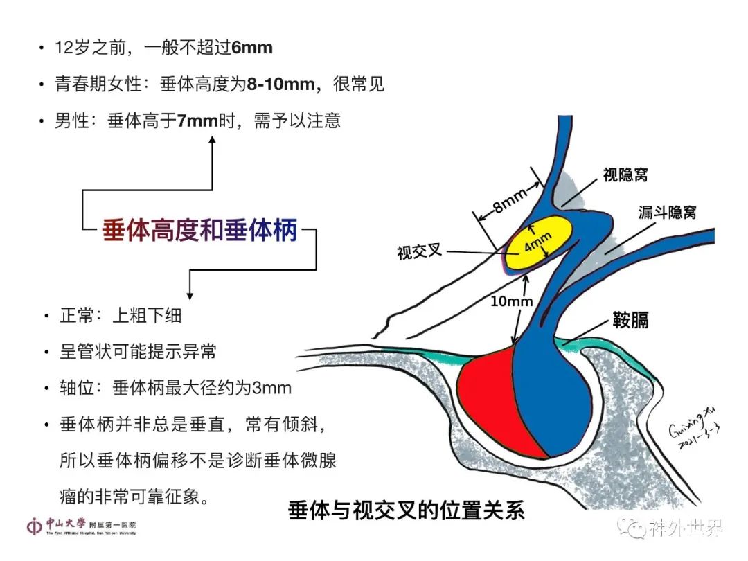 影像PPT - 【PPT】垂体瘤的多彩阅片-3