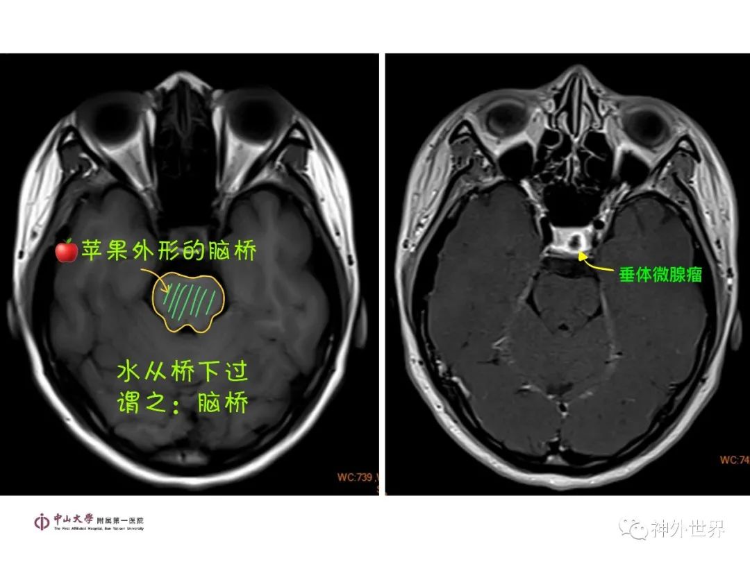 影像PPT - 【PPT】垂体瘤的多彩阅片-11
