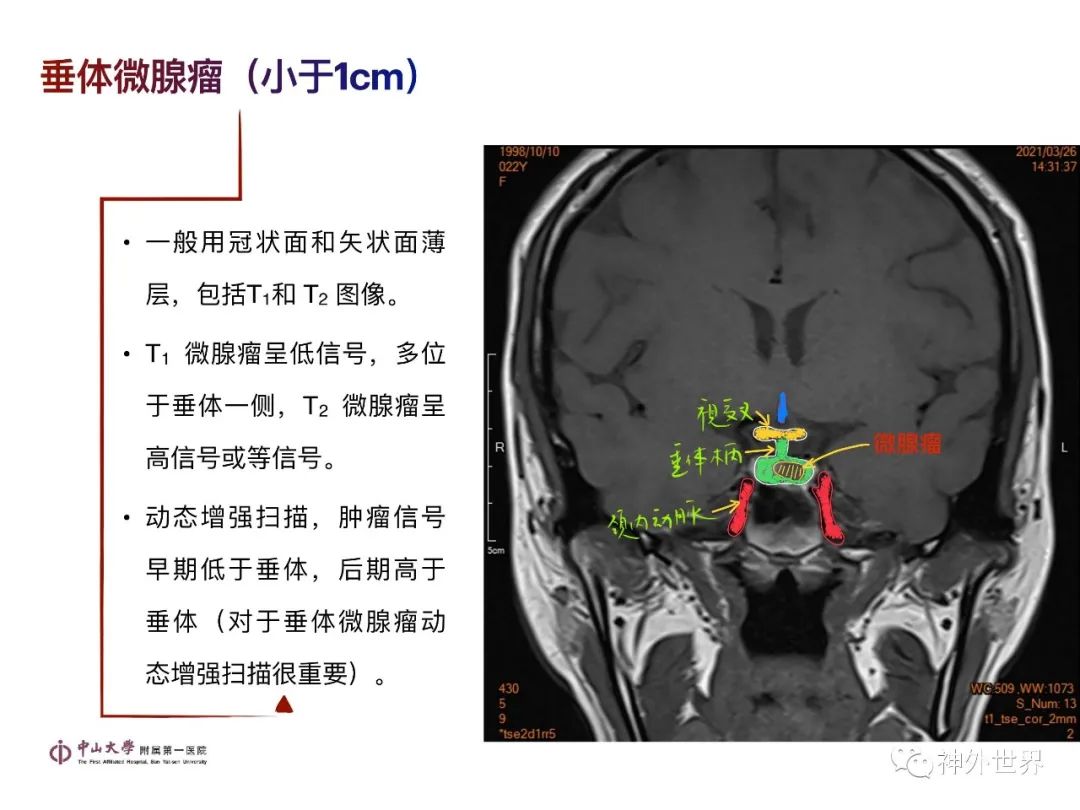 影像PPT - 【PPT】垂体瘤的多彩阅片-12