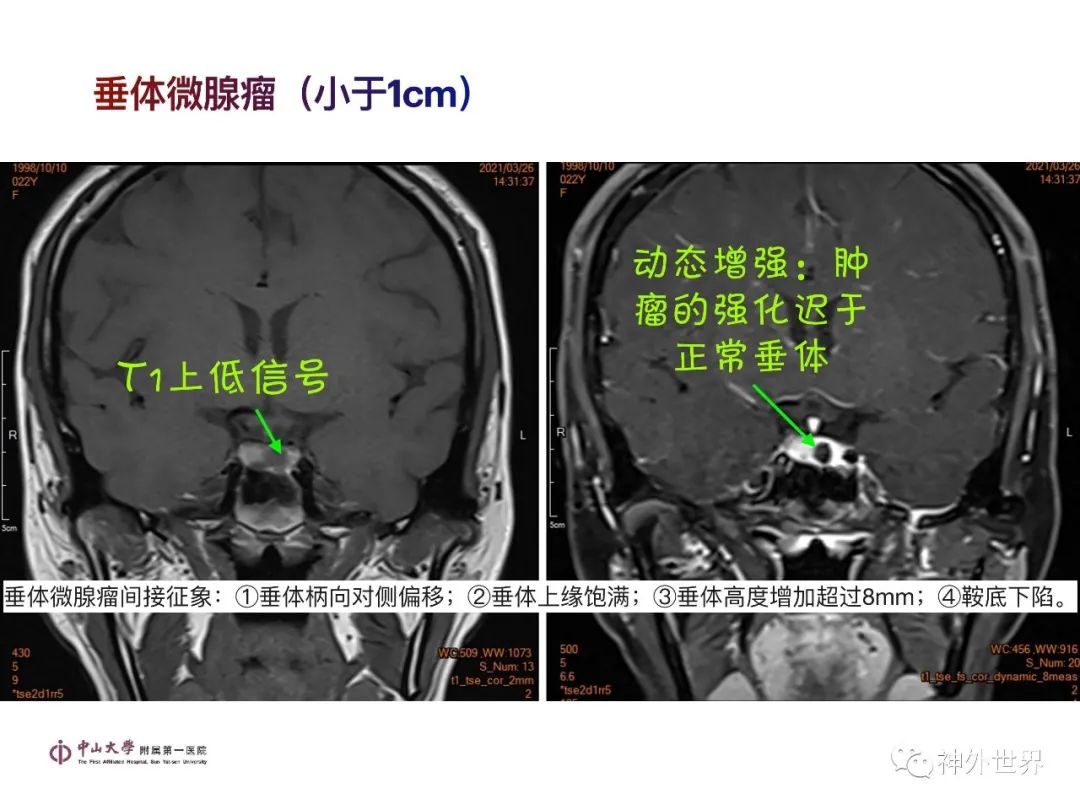 影像PPT - 【PPT】垂体瘤的多彩阅片-9