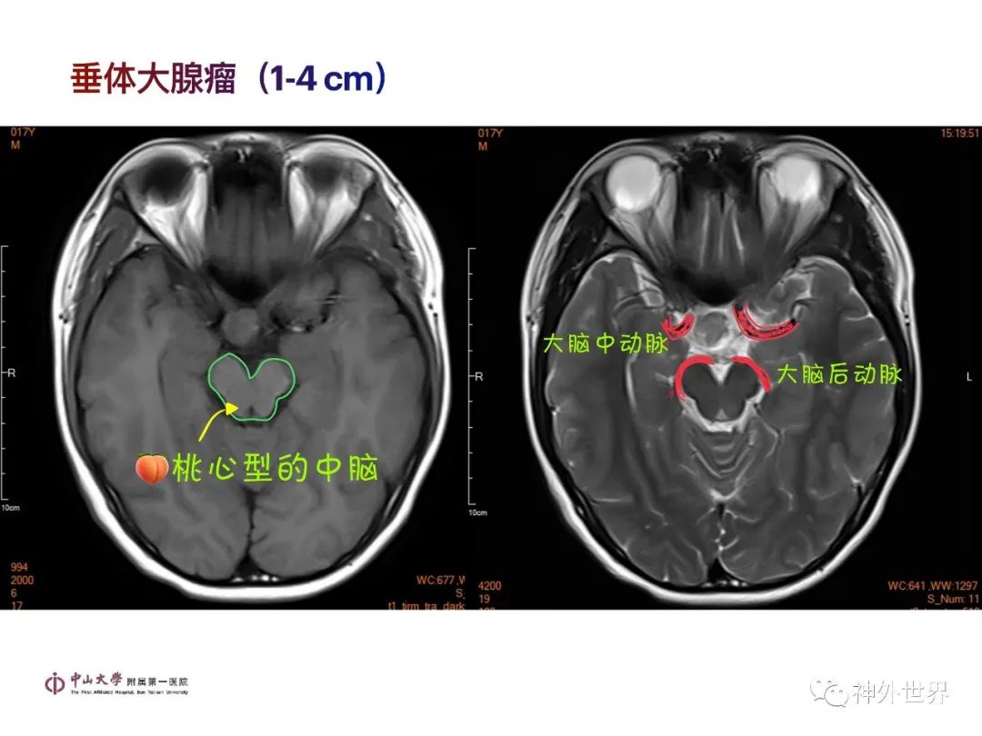 影像PPT - 【PPT】垂体瘤的多彩阅片-15