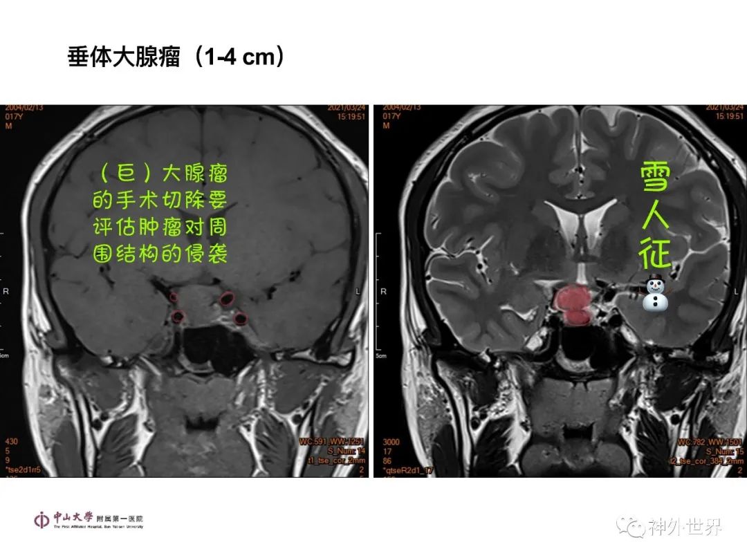 影像PPT - 【PPT】垂体瘤的多彩阅片-16