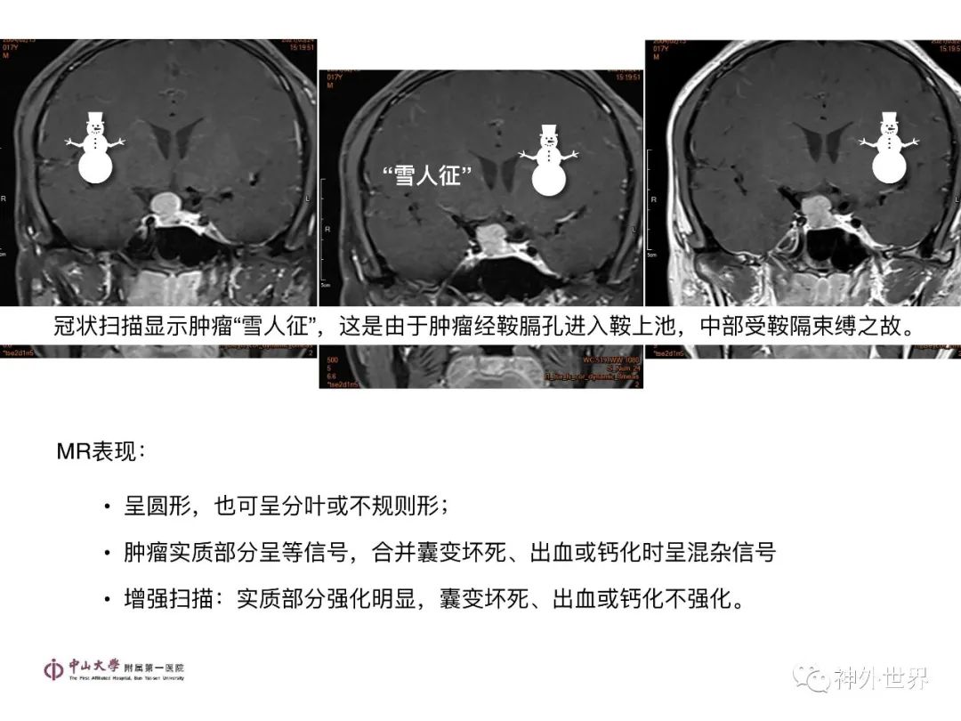 影像PPT - 【PPT】垂体瘤的多彩阅片-18