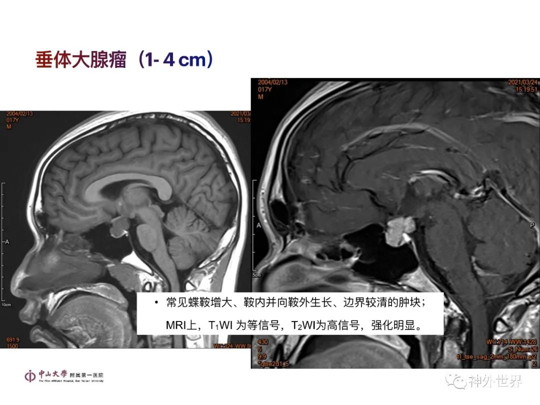 影像PPT - 【PPT】垂体瘤的多彩阅片-17