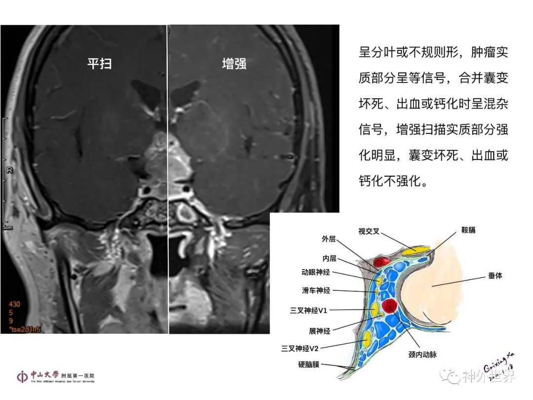 影像PPT - 【PPT】垂体瘤的多彩阅片-22