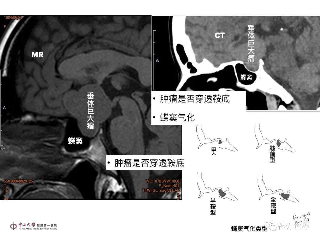 影像PPT - 【PPT】垂体瘤的多彩阅片-23