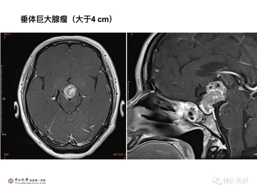 影像PPT - 【PPT】垂体瘤的多彩阅片-21