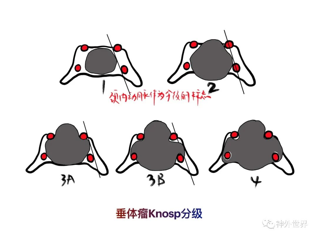 影像PPT - 【PPT】垂体瘤的多彩阅片-24