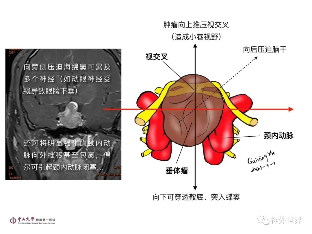 影像PPT - 【PPT】垂体瘤的多彩阅片-25