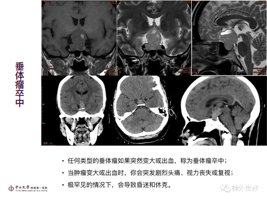 影像PPT - 【PPT】垂体瘤的多彩阅片-26