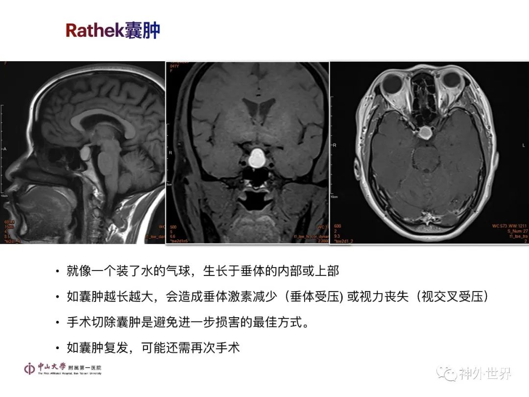 影像PPT - 【PPT】垂体瘤的多彩阅片-27