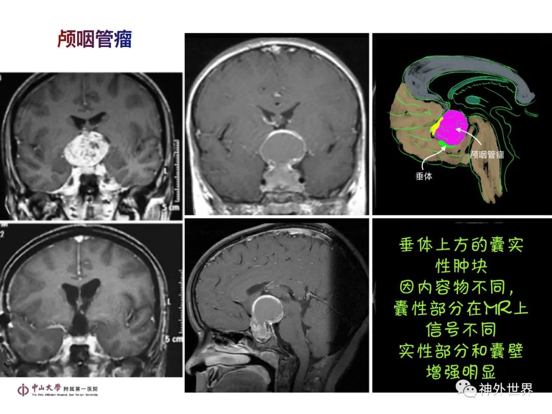 影像PPT - 【PPT】垂体瘤的多彩阅片-29