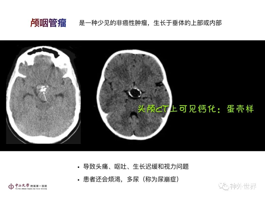 影像PPT - 【PPT】垂体瘤的多彩阅片-30