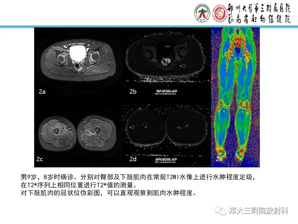 影像PPT - 【PPT】MRI在进行性肌营养不良中的诊断优势-7