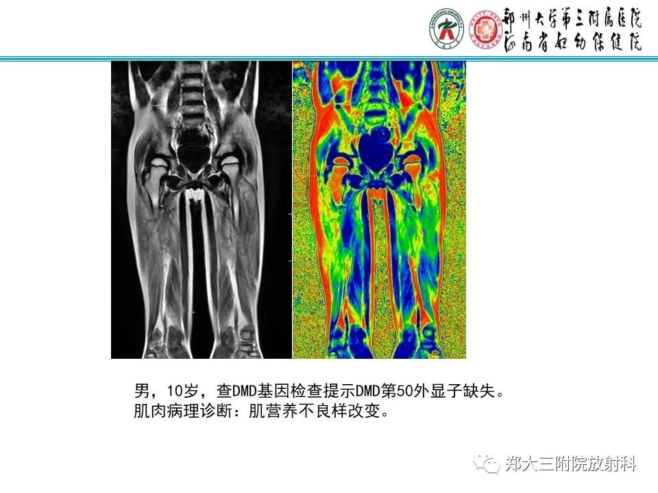 影像PPT - 【PPT】MRI在进行性肌营养不良中的诊断优势-8