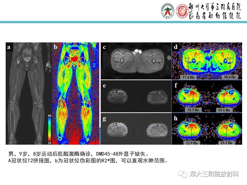 影像PPT - 【PPT】MRI在进行性肌营养不良中的诊断优势-10