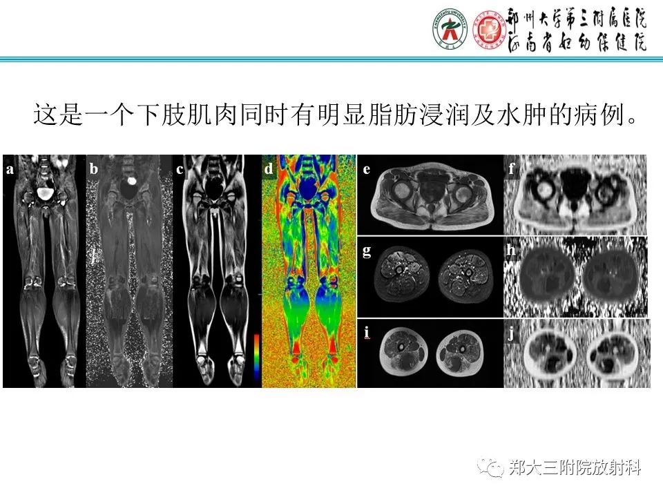 影像PPT - 【PPT】MRI在进行性肌营养不良中的诊断优势-11