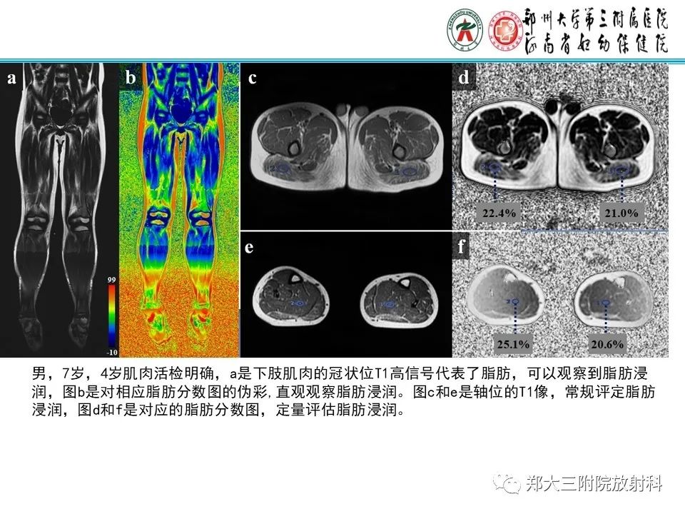 影像PPT - 【PPT】MRI在进行性肌营养不良中的诊断优势-9