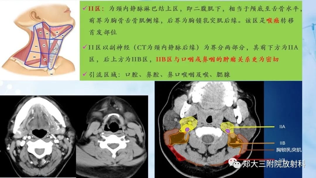 影像PPT - 【PPT】颈部淋巴结的分区及常见病变-7