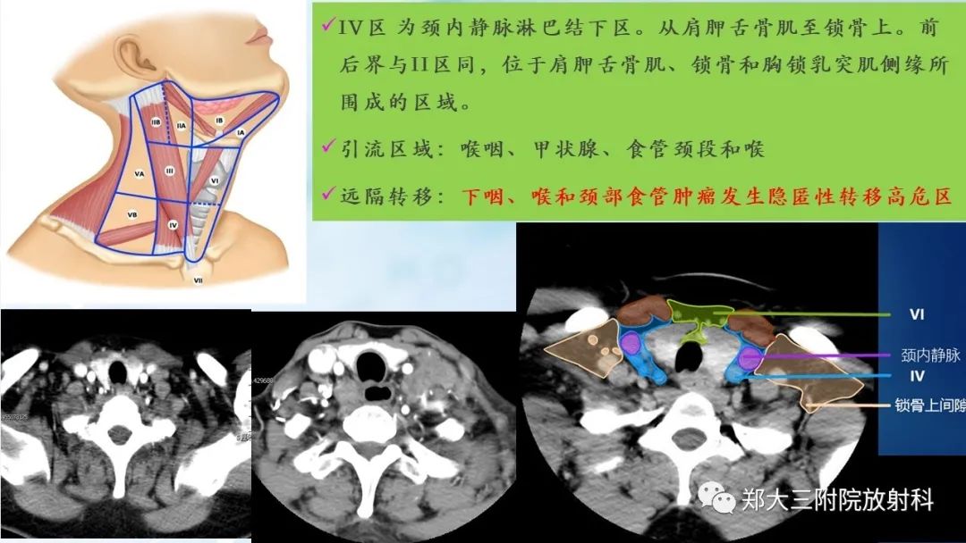 影像PPT - 【PPT】颈部淋巴结的分区及常见病变-9