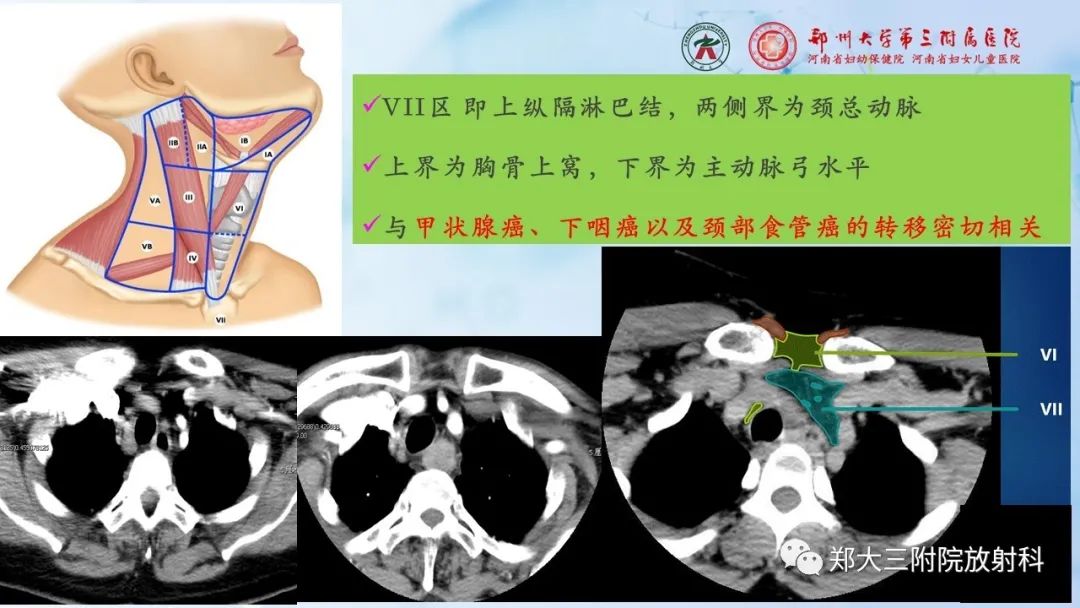 影像PPT - 【PPT】颈部淋巴结的分区及常见病变-12