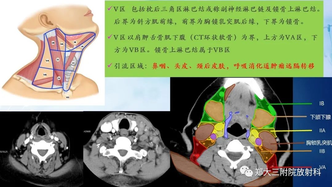 影像PPT - 【PPT】颈部淋巴结的分区及常见病变-10