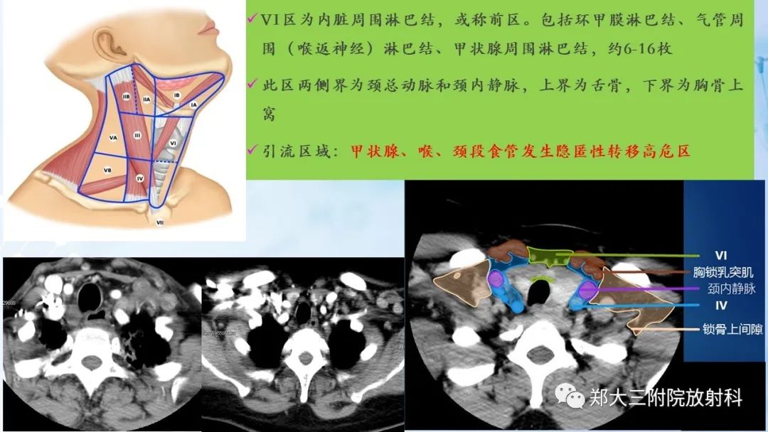 影像PPT - 【PPT】颈部淋巴结的分区及常见病变-11