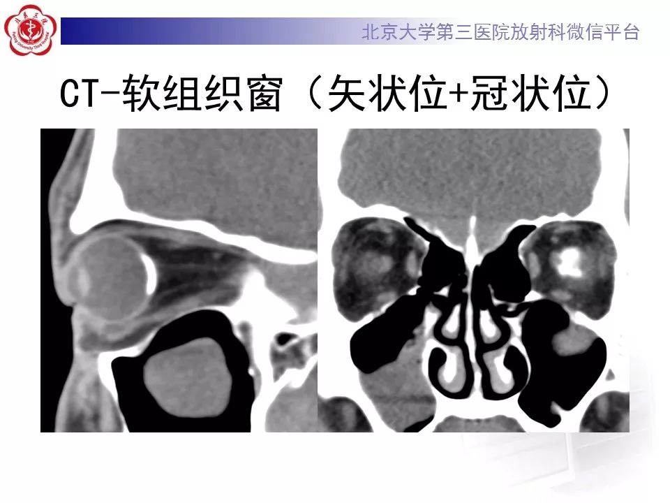 影像PPT - 【PPT】脉络膜骨瘤的影像表现-5