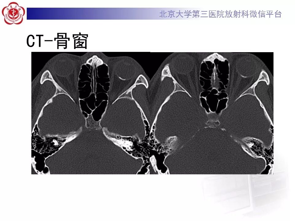 影像PPT - 【PPT】脉络膜骨瘤的影像表现-3
