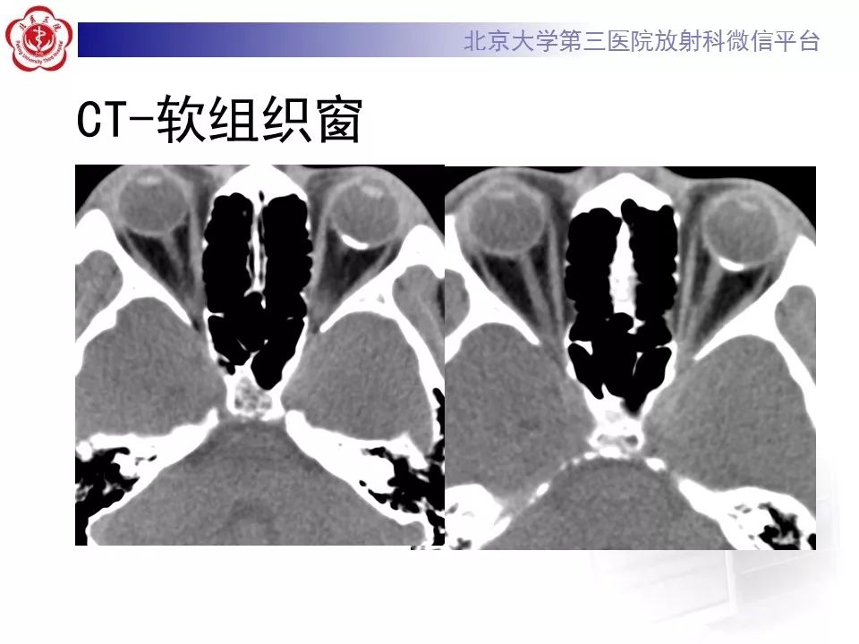 影像PPT - 【PPT】脉络膜骨瘤的影像表现-4