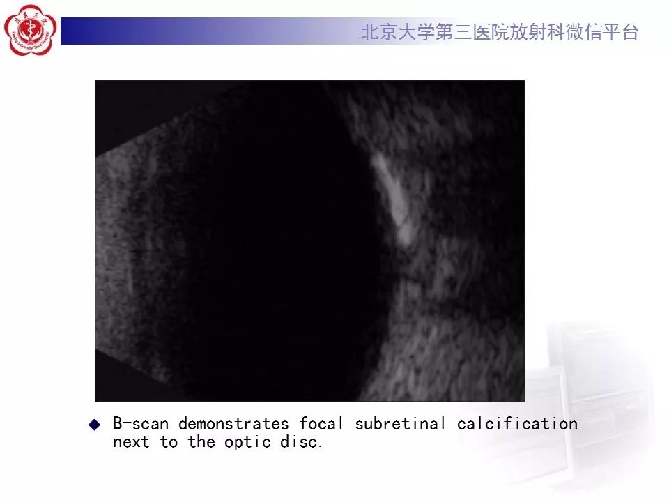 影像PPT - 【PPT】脉络膜骨瘤的影像表现-21