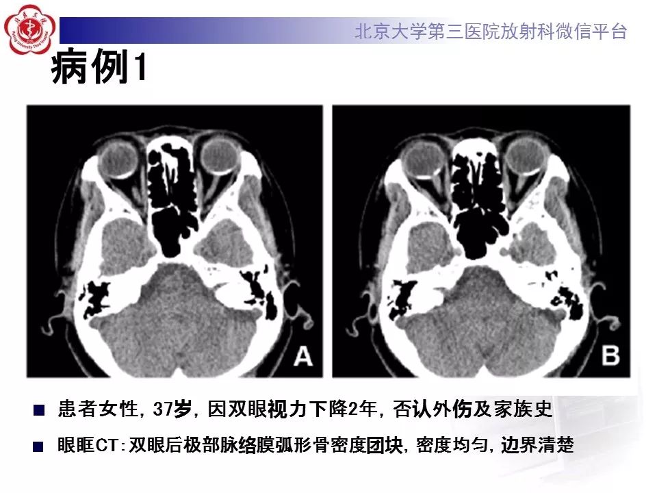 影像PPT - 【PPT】脉络膜骨瘤的影像表现-22